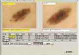 DDAX-3 Software per imaging diagnostico e diagnosi assistita delle lesioni cutanee