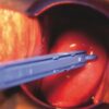 Gyn & push pinza monouso sterile per biopsia cervicale caso applicativo