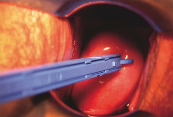 Gyn & push pinza monouso sterile per biopsia cervicale caso applicativo