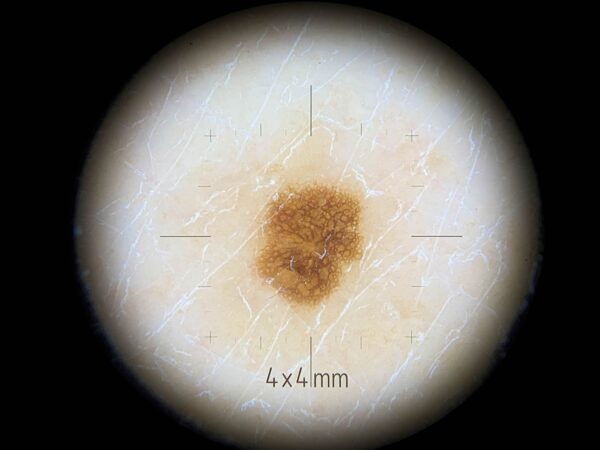 lesione cutanea vista con piastrina di contatto con scala dermlite dl4